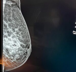 marcadores suturables de carbono en mama mamografia